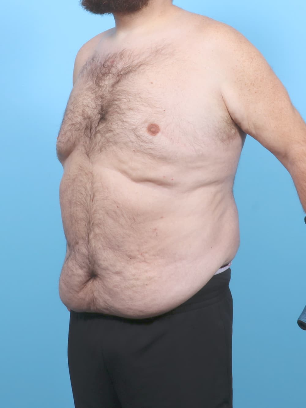Tummy Tuck case #7122 before, image 2