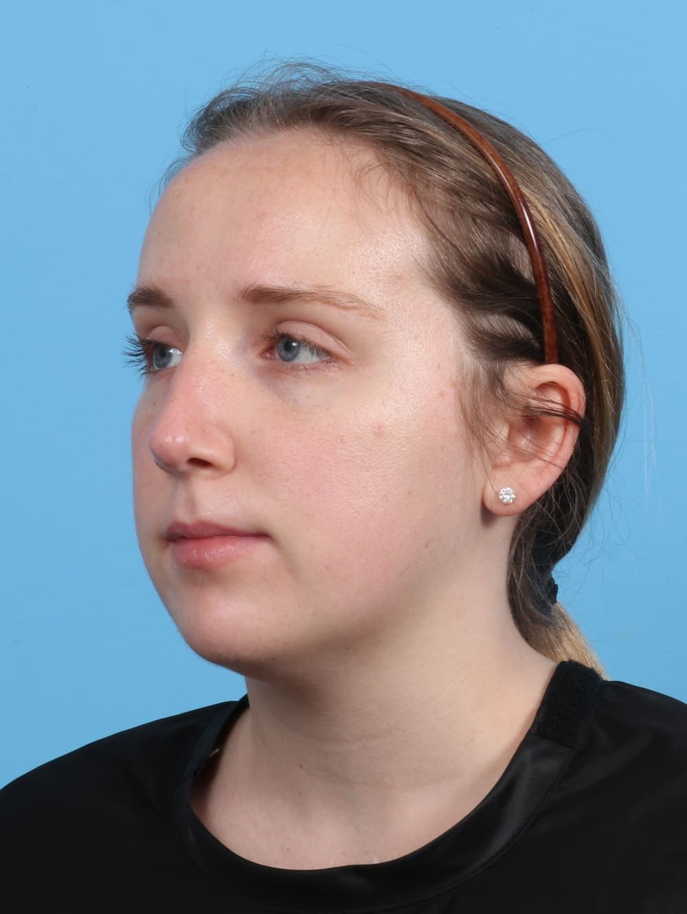 Rhinoplasty case #3486 after, image 3
