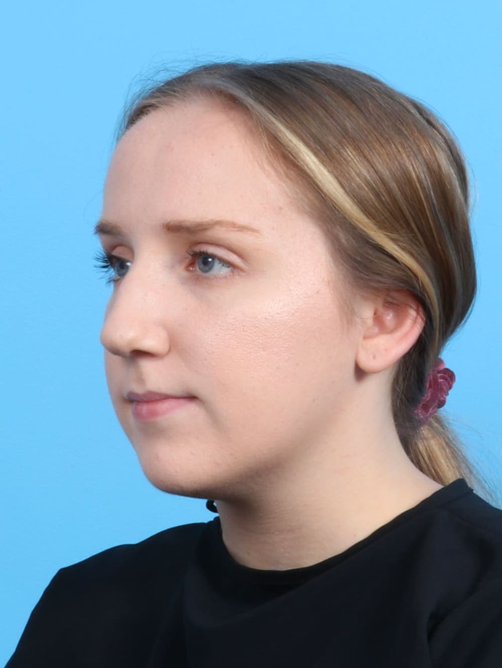 Rhinoplasty case #3486 before, image 3
