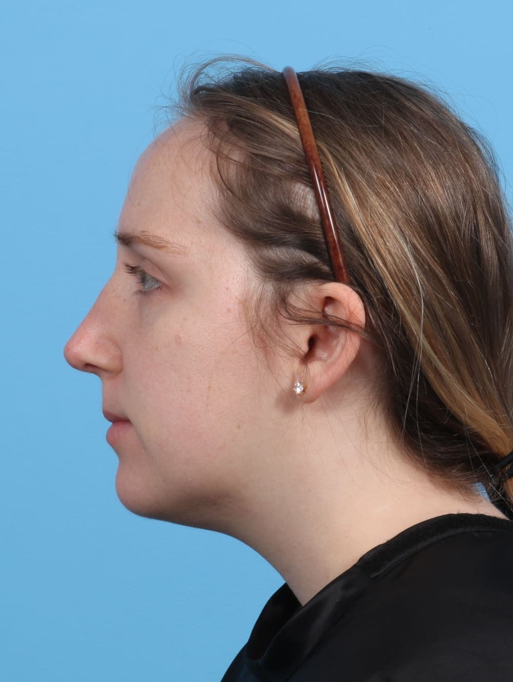 Rhinoplasty case #3486 after, image 1