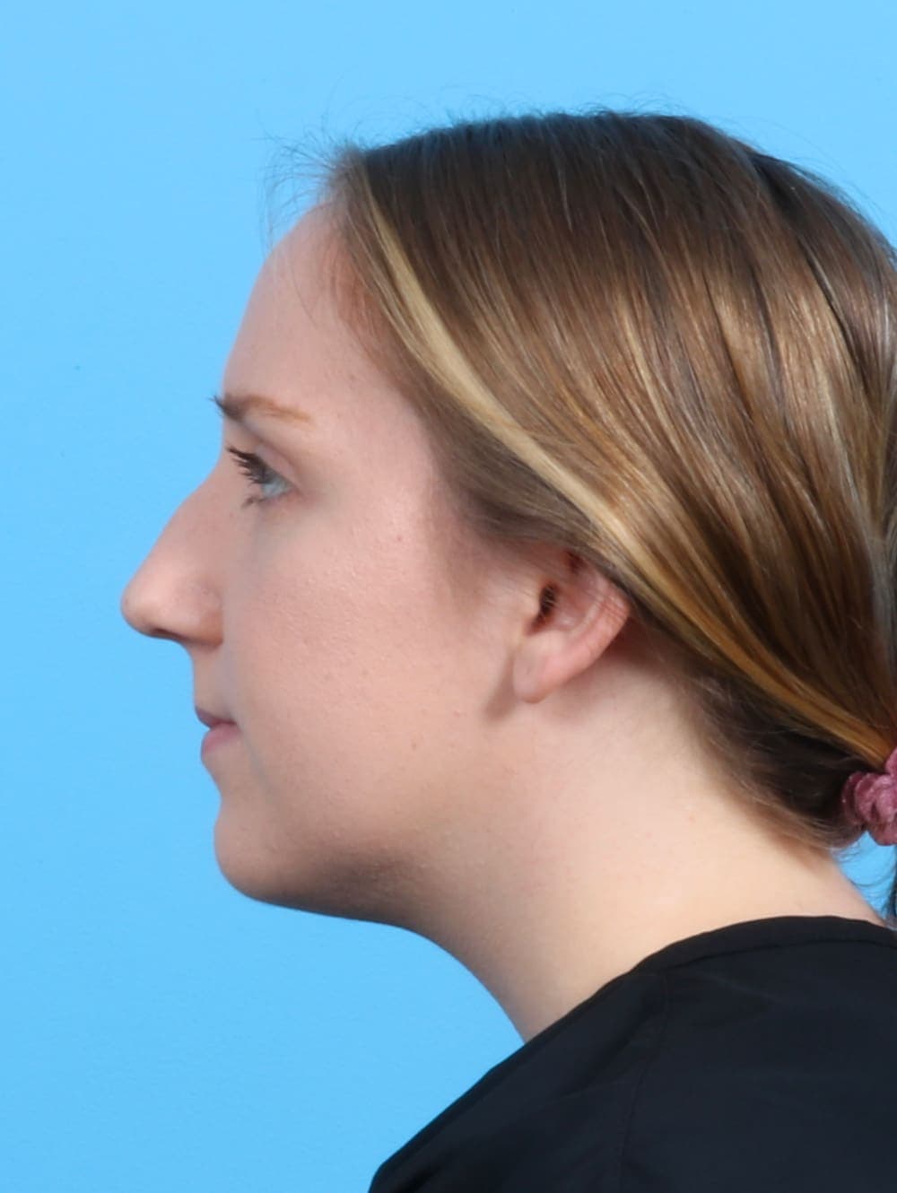Rhinoplasty case #3486 before, image 1