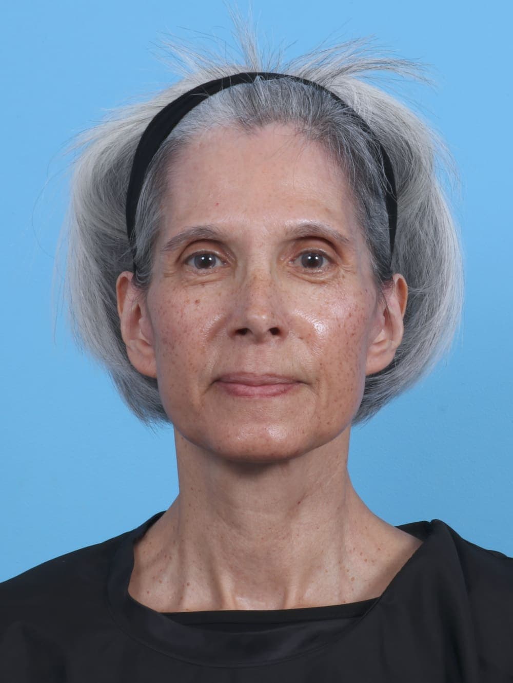 Facial Surgery case #4411 after