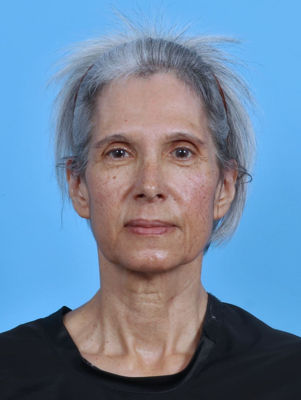 Facial Surgery case #4411 before