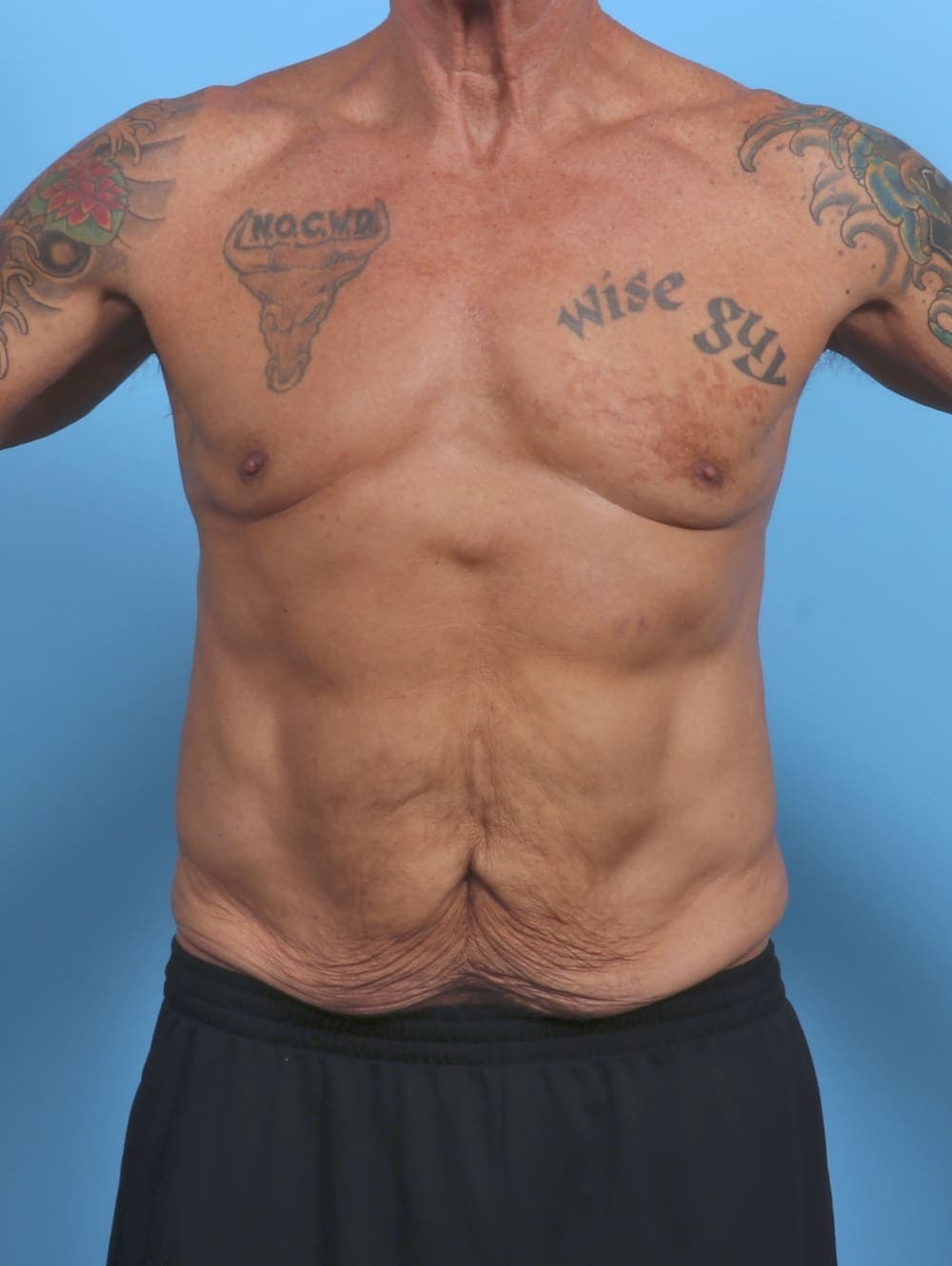 Tummy Tuck case #5610 before, image 1