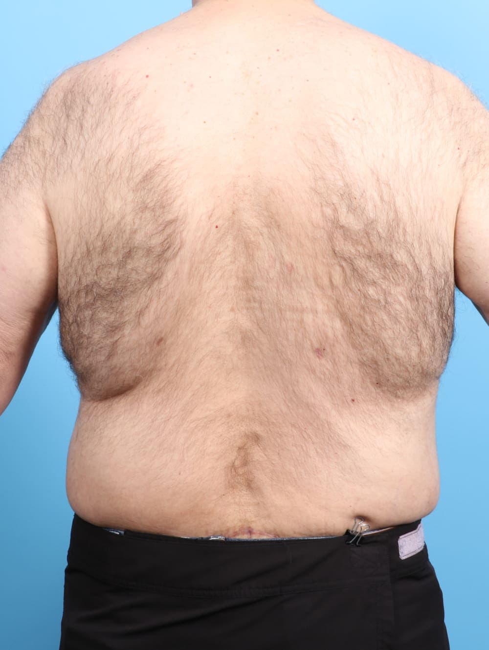 Body Lift case #2550 after, image 4