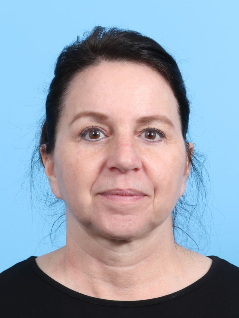 Eyelid Surgery case #2266 after