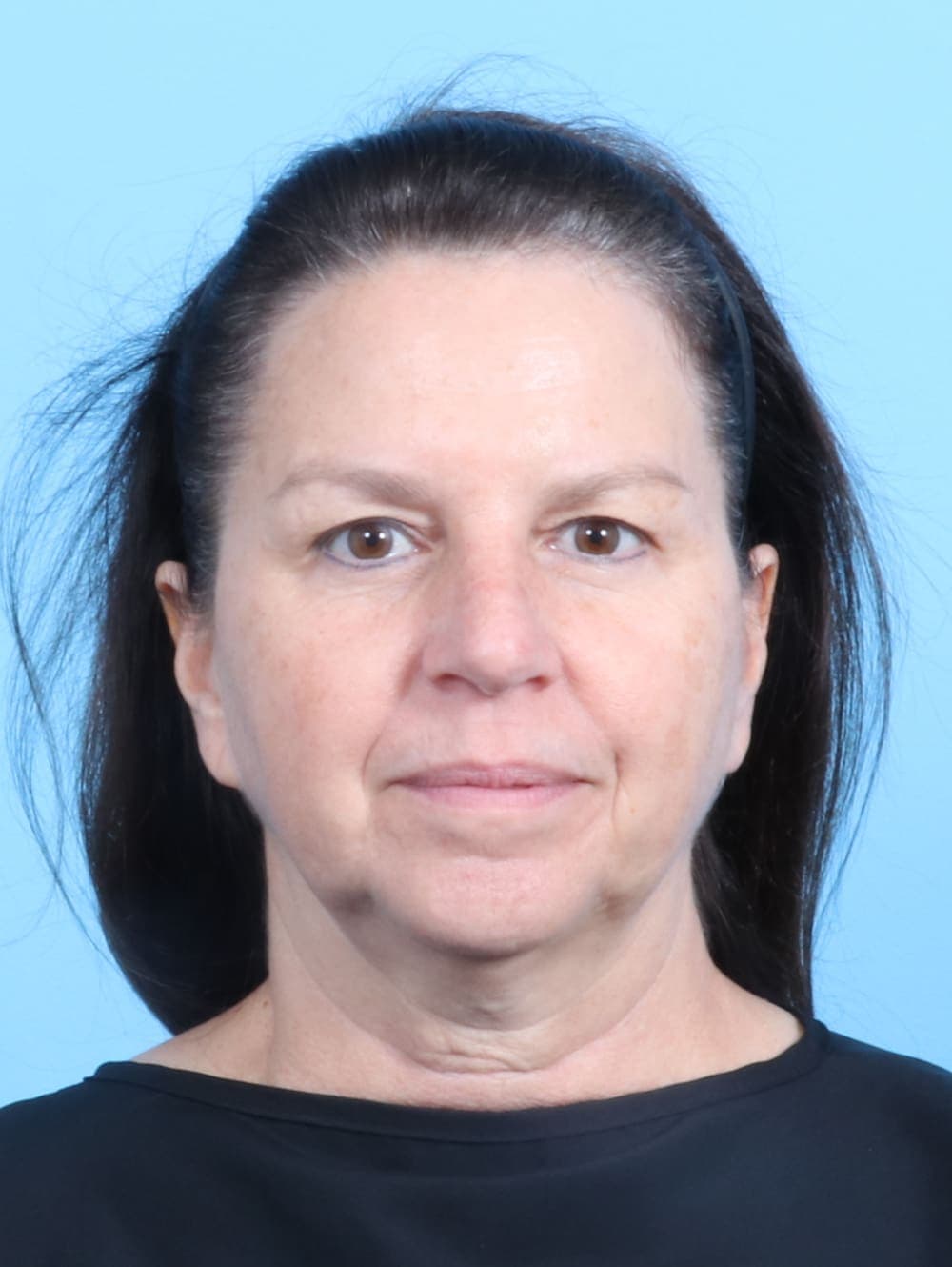 Eyelid Surgery case #2266 before