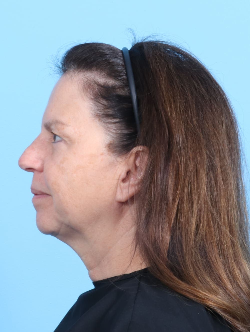 Eyelid Surgery case #2266 before, image 3