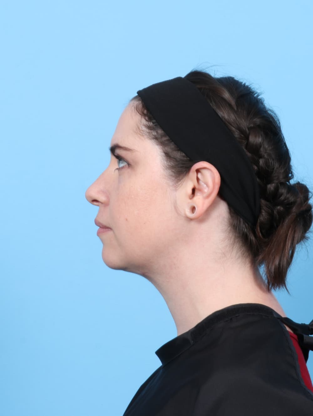 Facial Surgery case #7372 after
