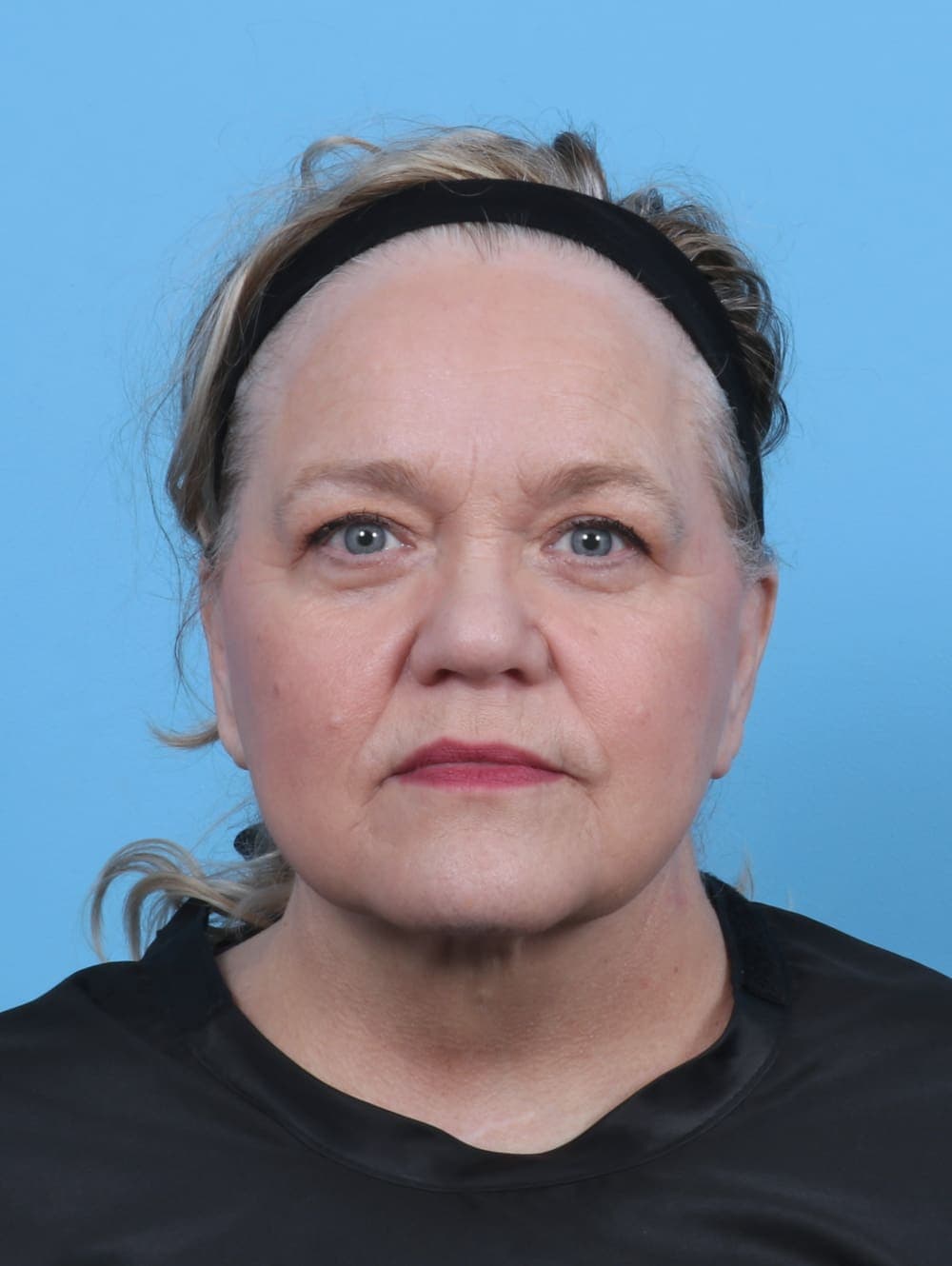 Facial Surgery case #5668 after