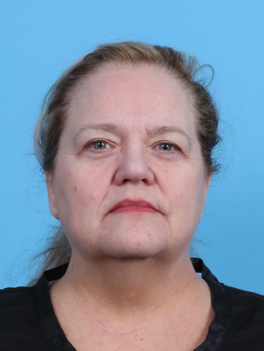 Facial Surgery case #5668 before