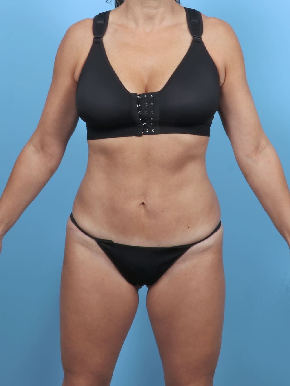 Liposuction case #5857 after