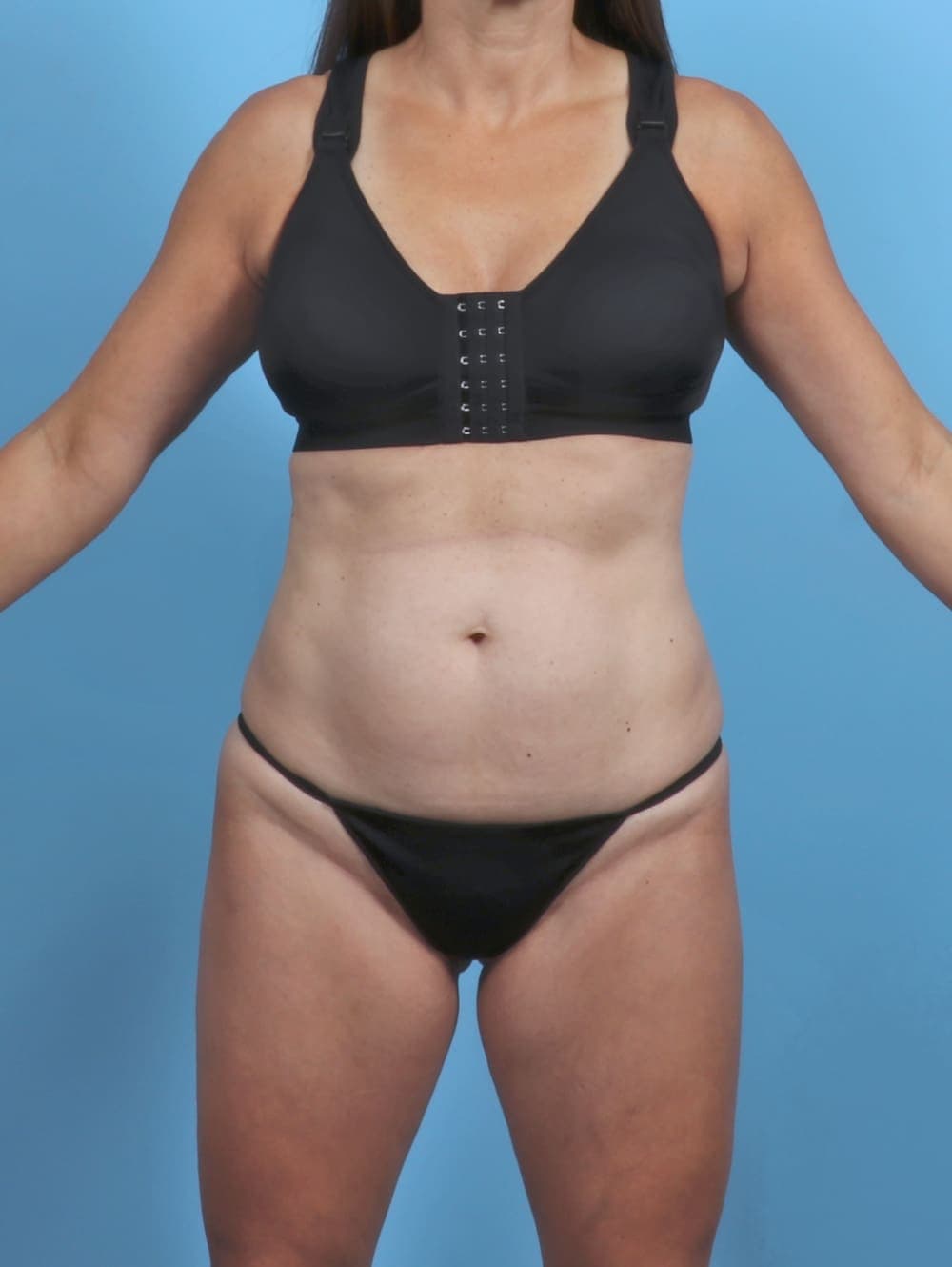 Liposuction case #5857 before