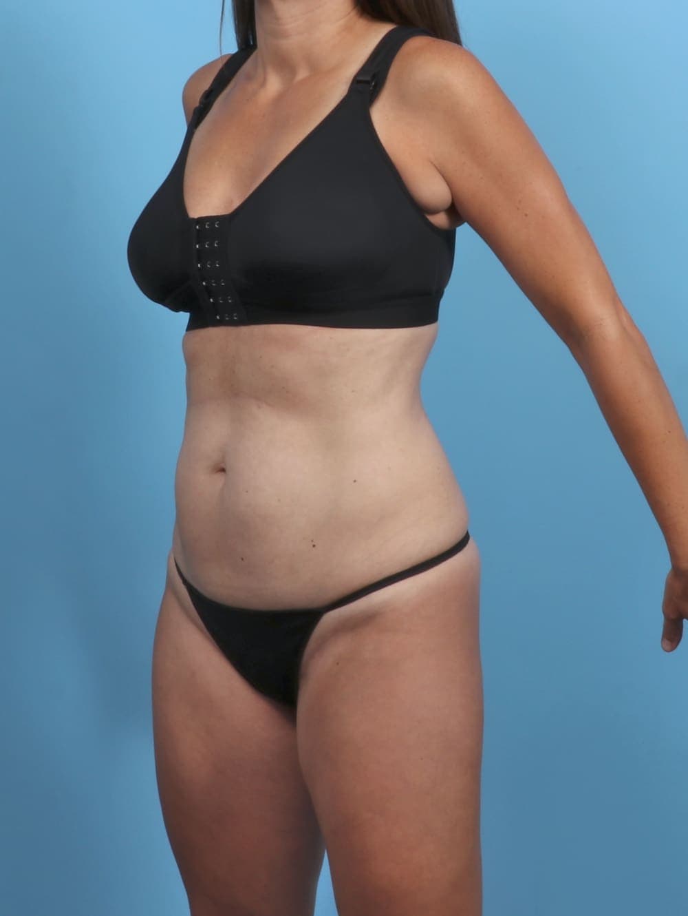 Liposuction case #5857 before, image 2