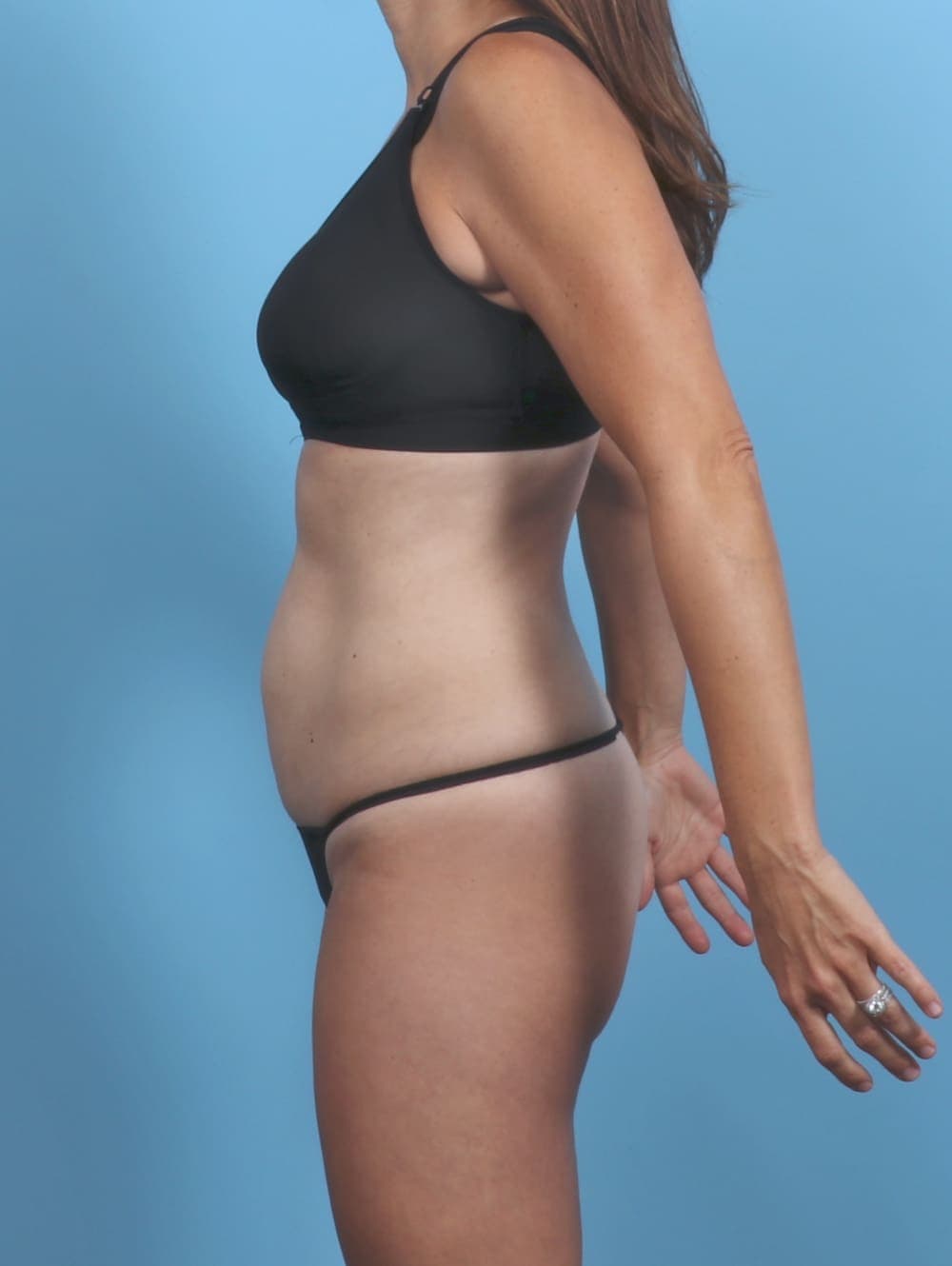 Liposuction case #5857 before, image 3