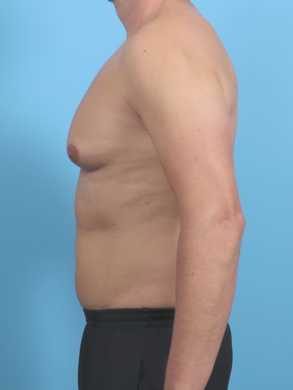 Male Breast Reduction case #5873 before, image 3