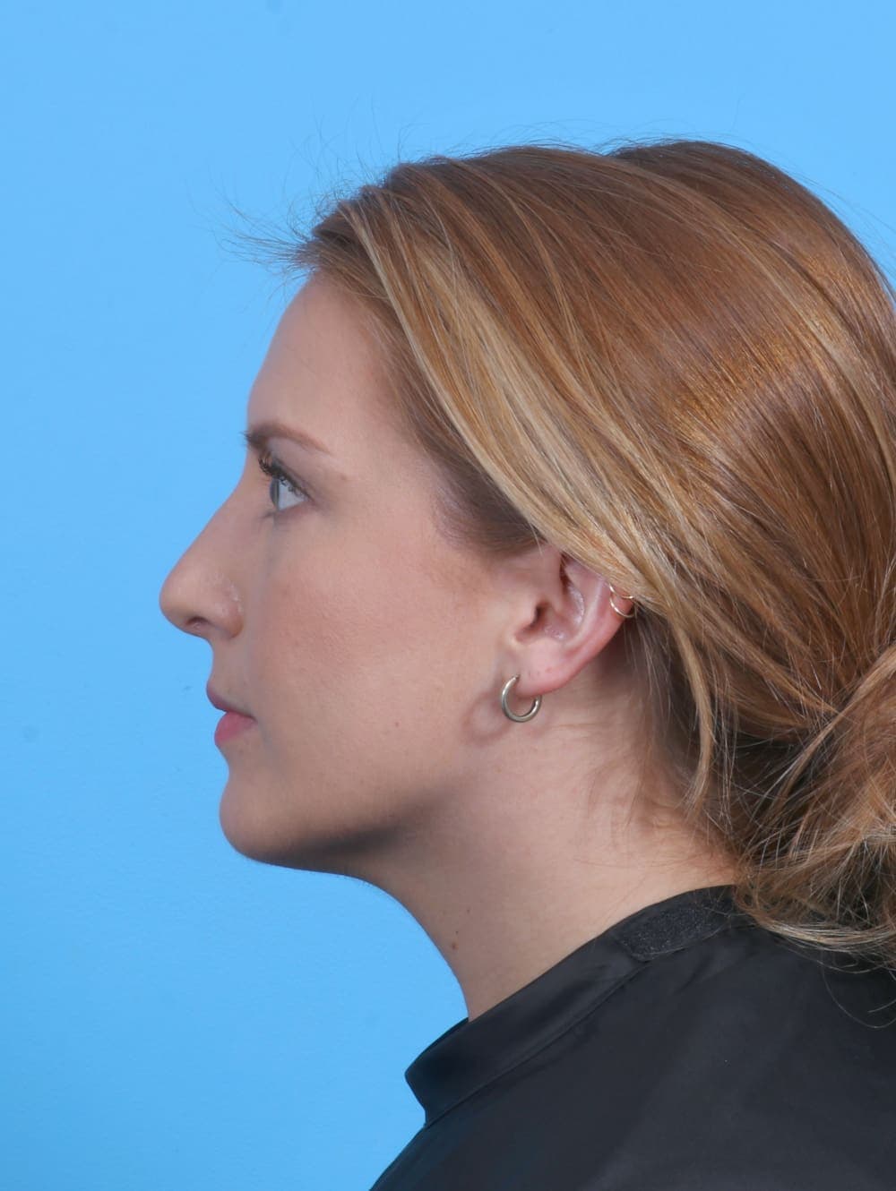 Rhinoplasty case #4229 after, image 1