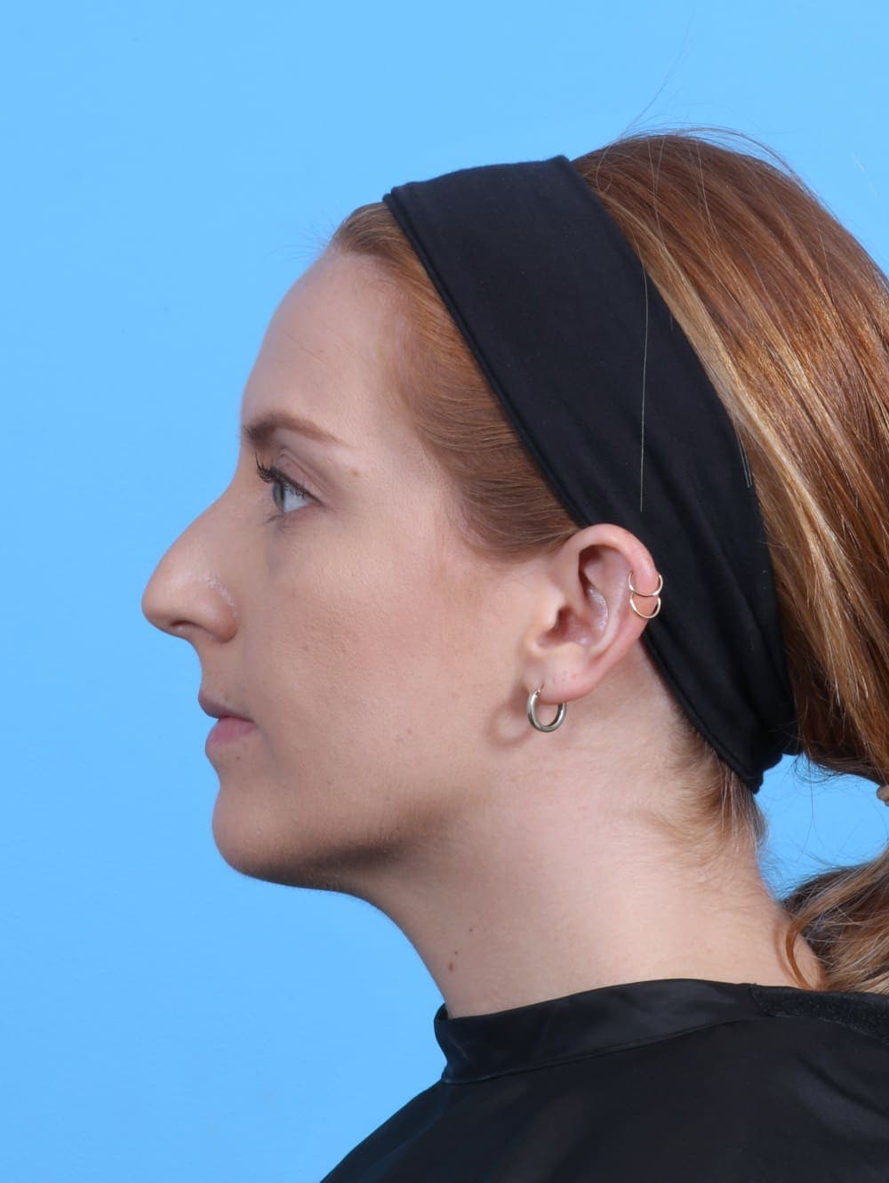 Rhinoplasty case #4229 before, image 1