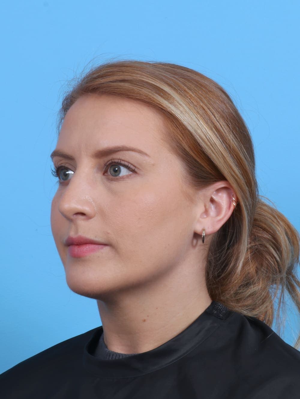 Rhinoplasty case #4229 after, image 3