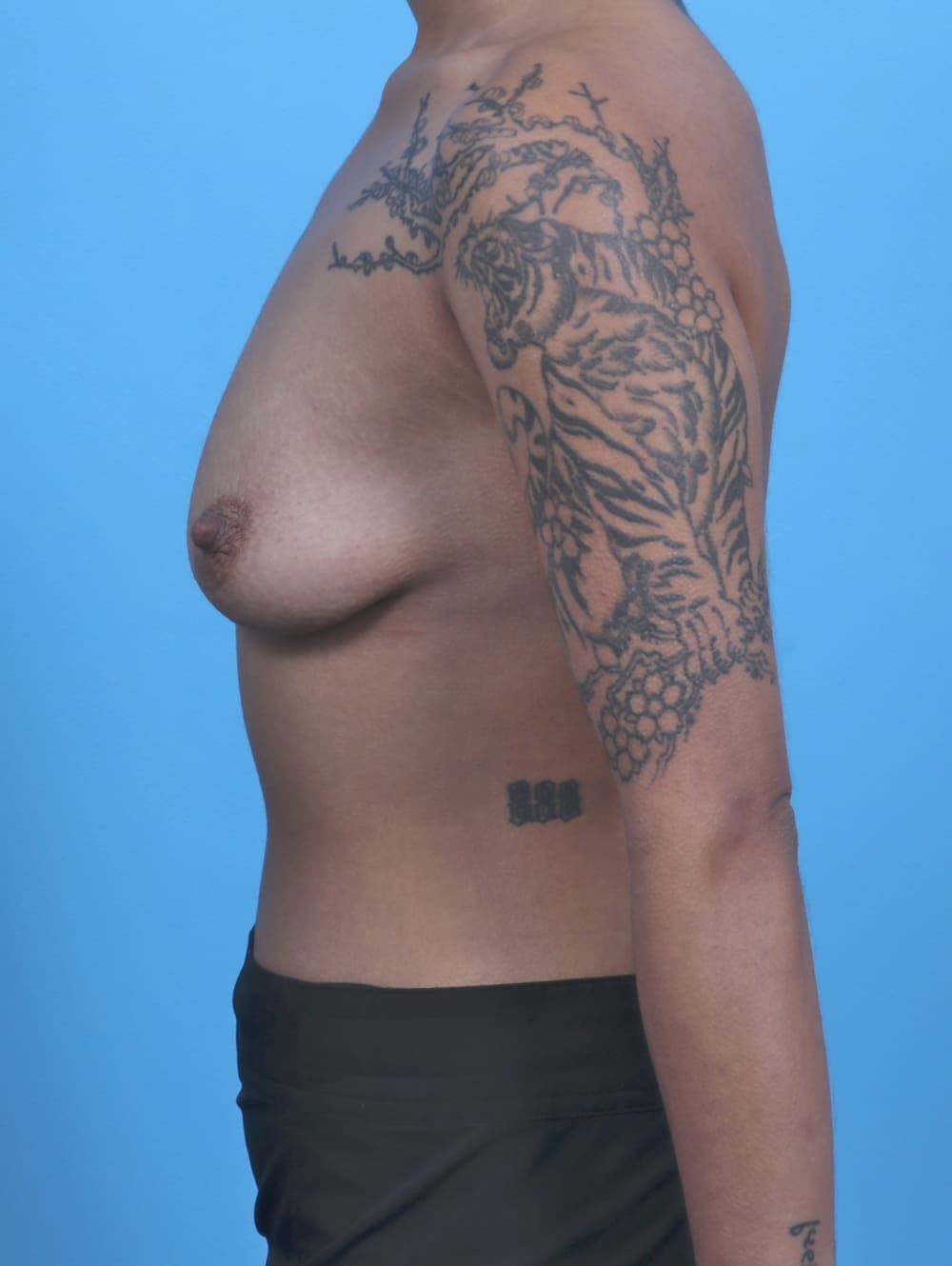 Breast Lift with Implants case #5781 before, image 3