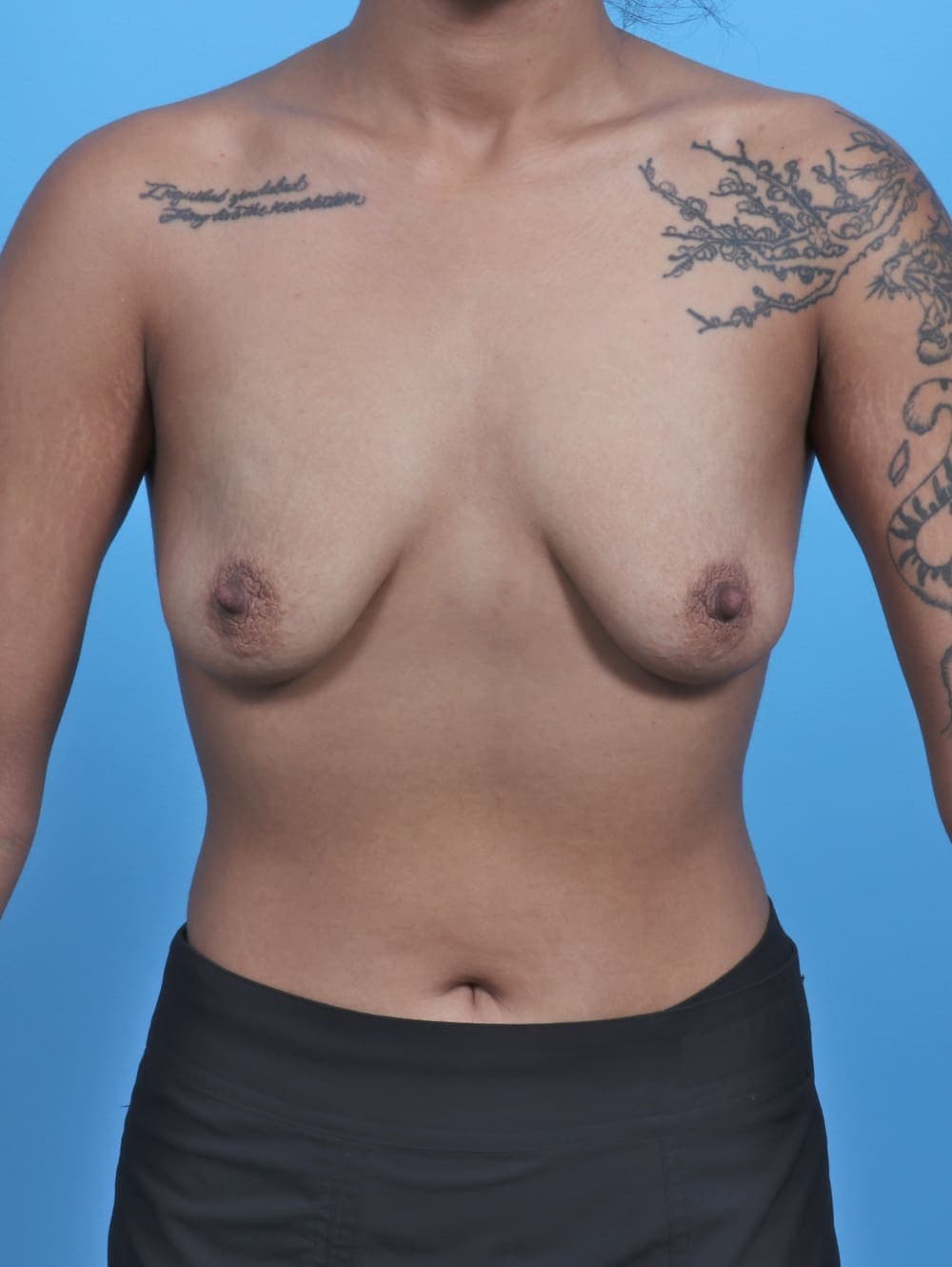 Breast Lift with Implants case #5781 before