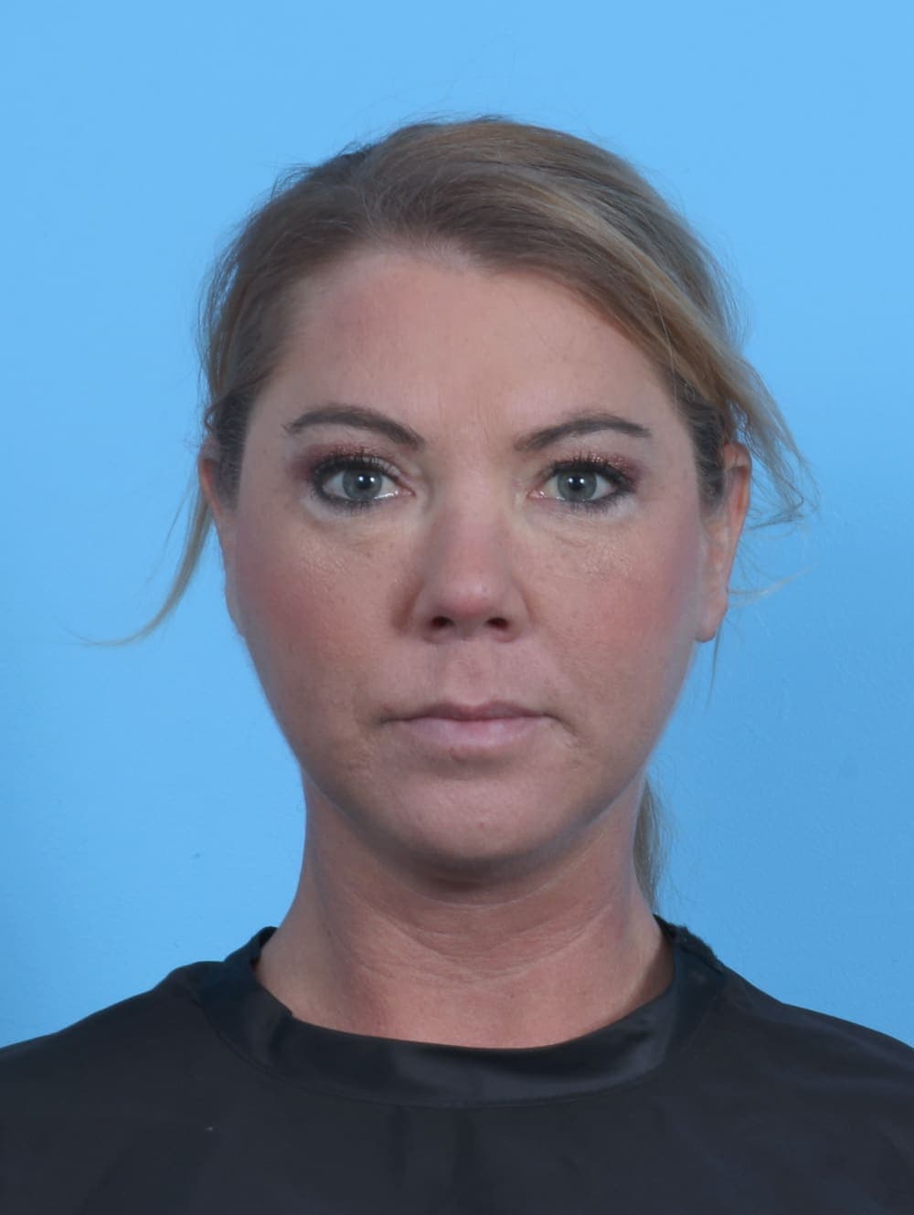 Eyelid Surgery case #4339 after