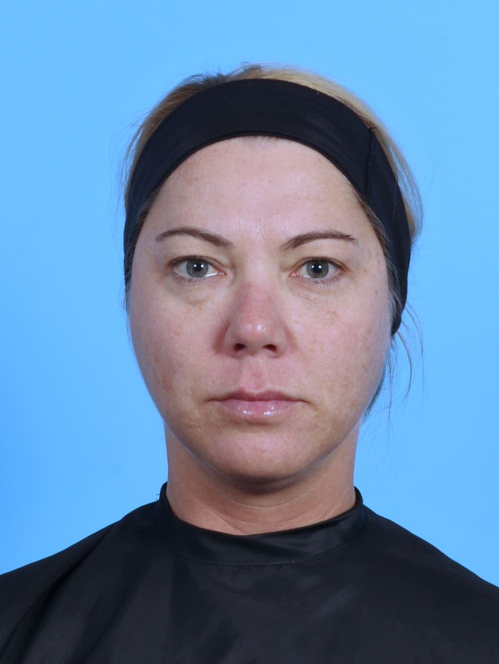 Eyelid Surgery case #4339 before