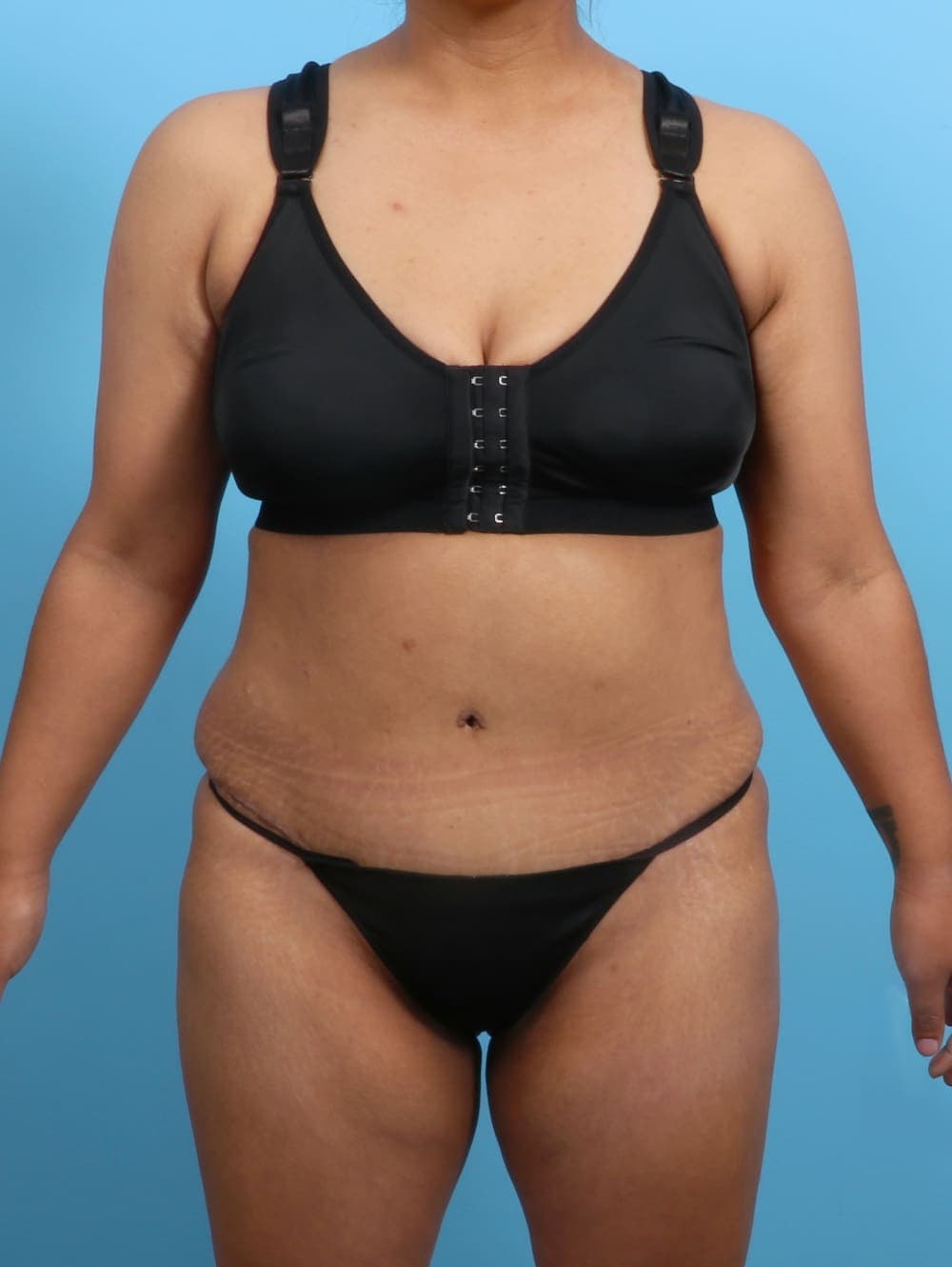 Tummy Tuck case #3327 after, image 1