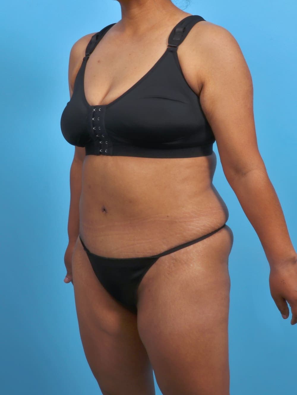 Tummy Tuck case #3327 after, image 2