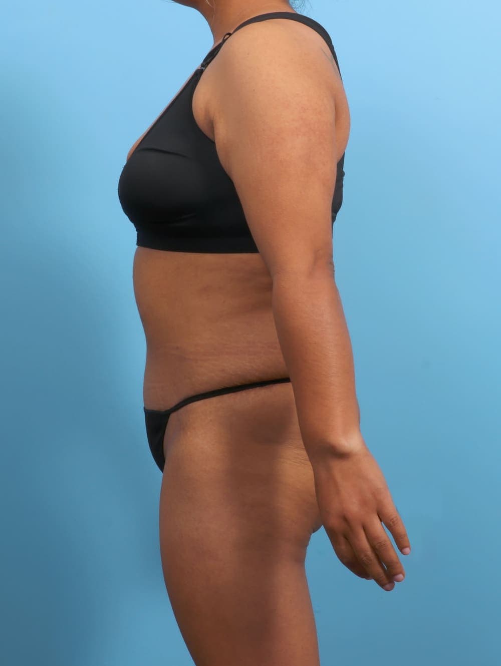 Tummy Tuck case #3327 after, image 3