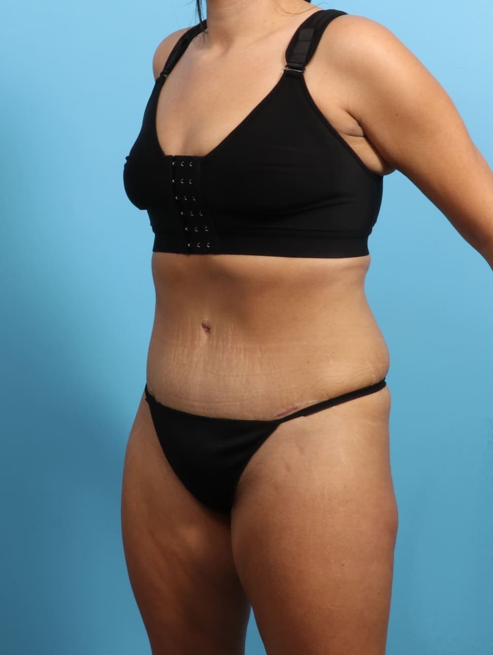 Tummy Tuck case #3026 after, image 2