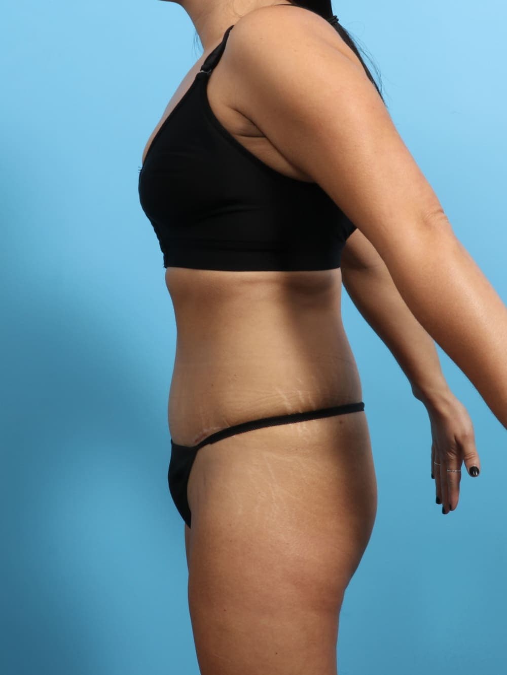 Tummy Tuck case #3026 after, image 3