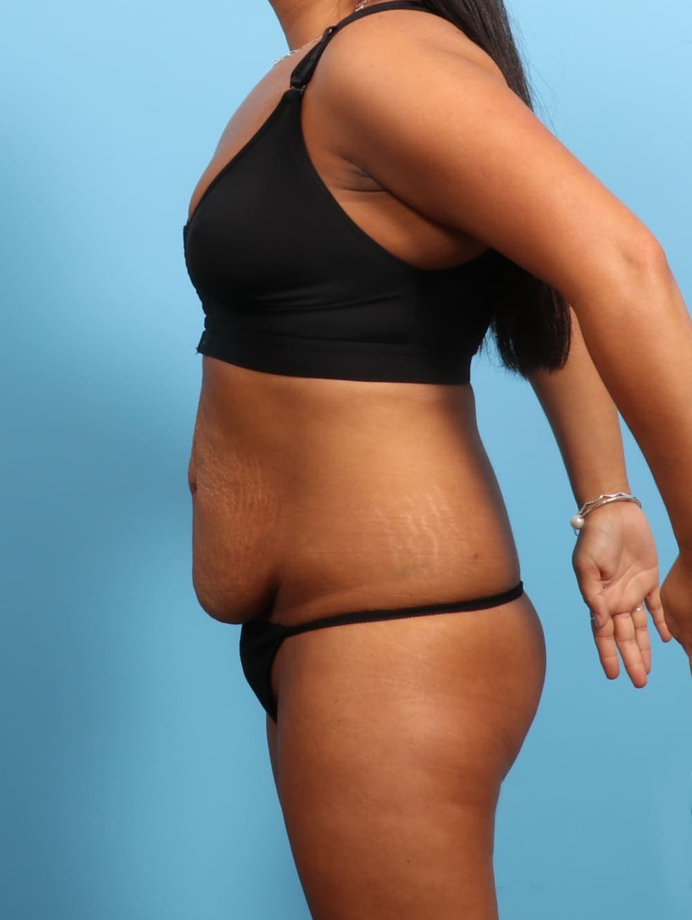 Tummy Tuck case #3026 before, image 3
