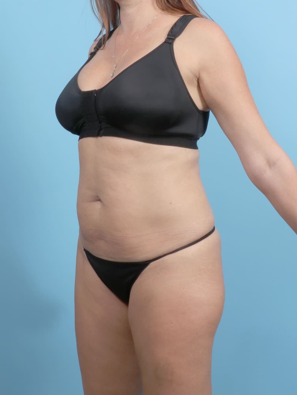 Tummy Tuck case #6767 before, image 2