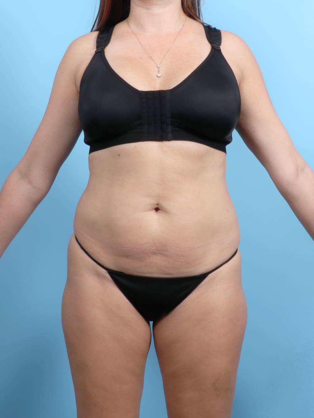 Tummy Tuck case #6767 before
