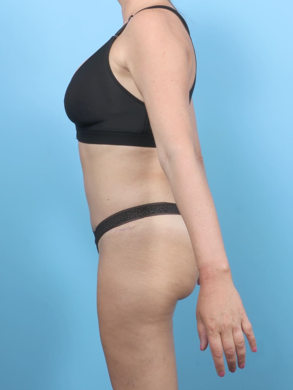 Tummy Tuck case #6767 after, image 3