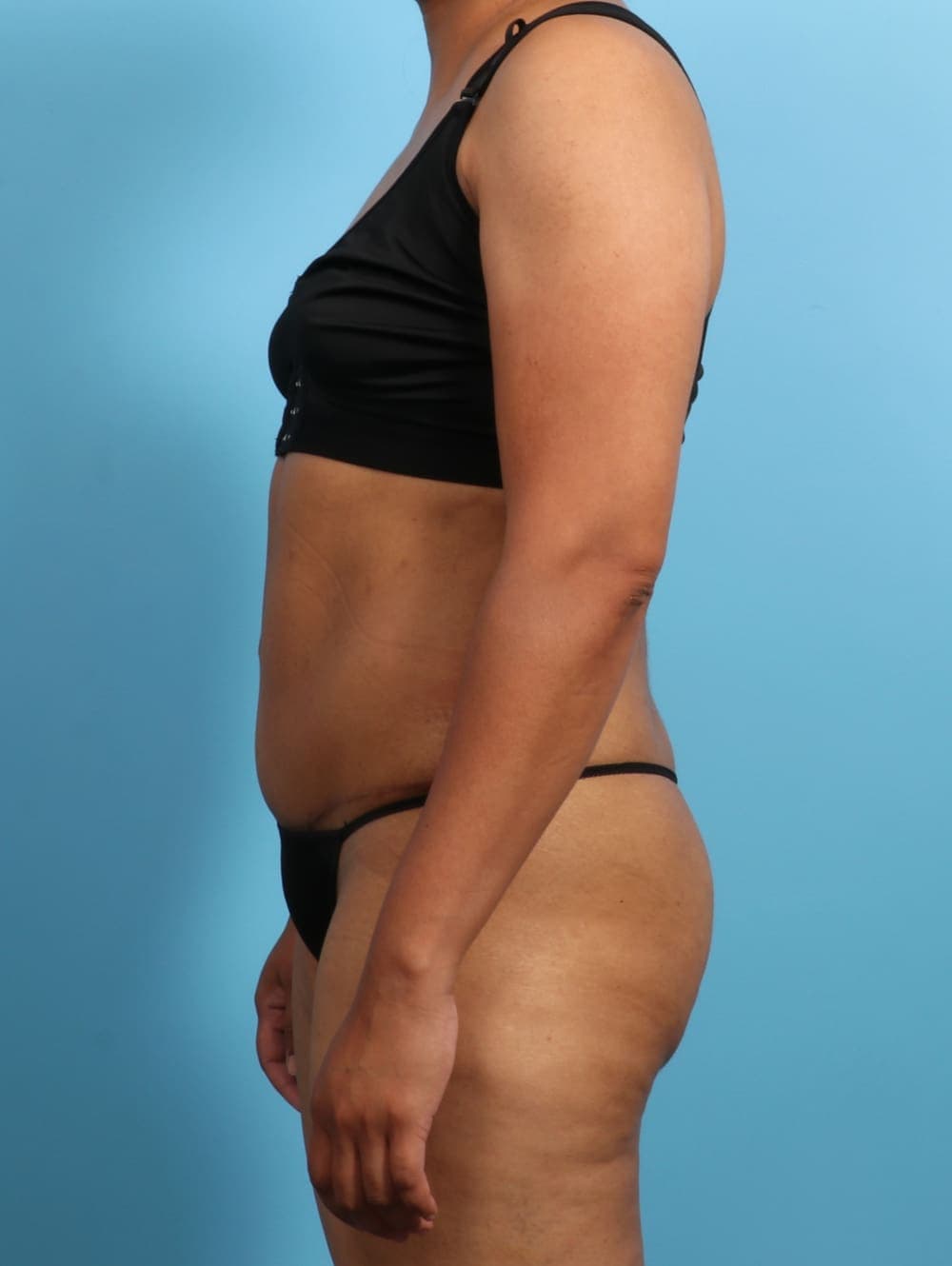 Tummy Tuck case #2711 after, image 3