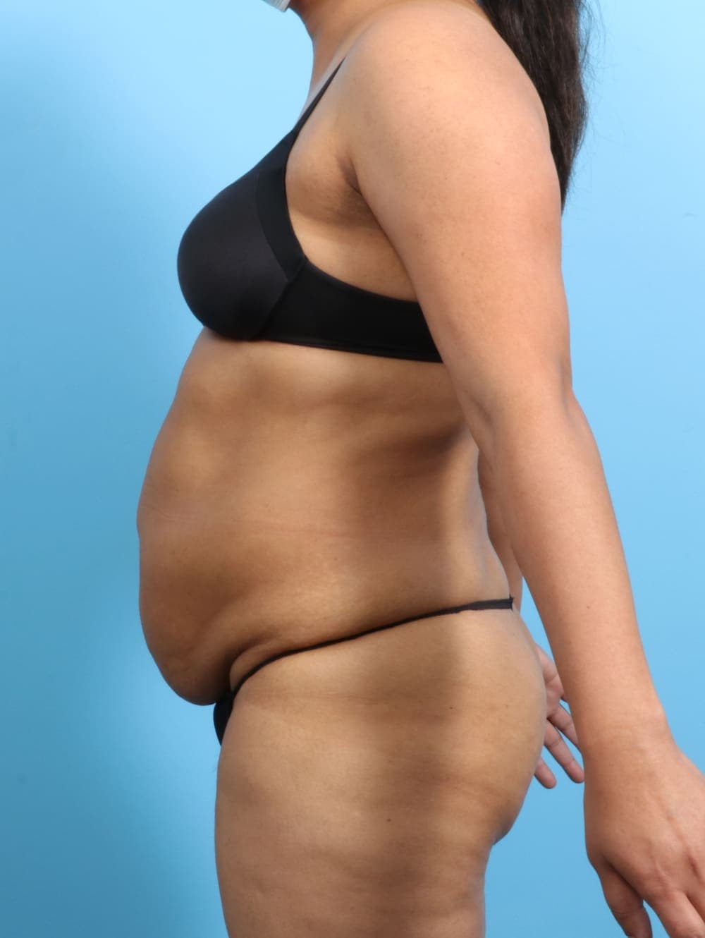Tummy Tuck case #2711 before, image 3