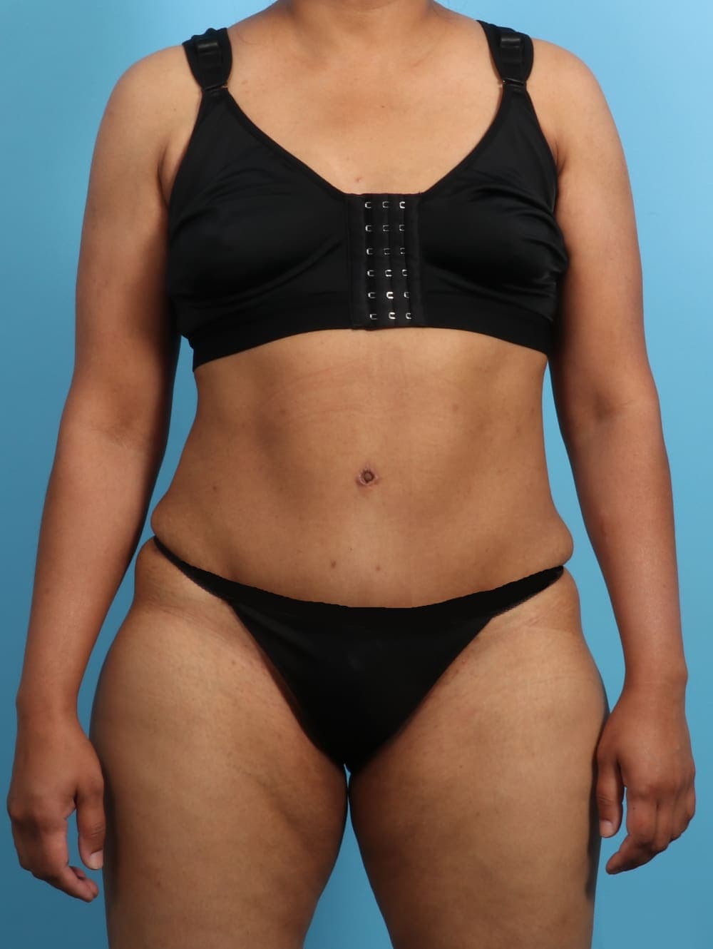Liposuction case #2711 after
