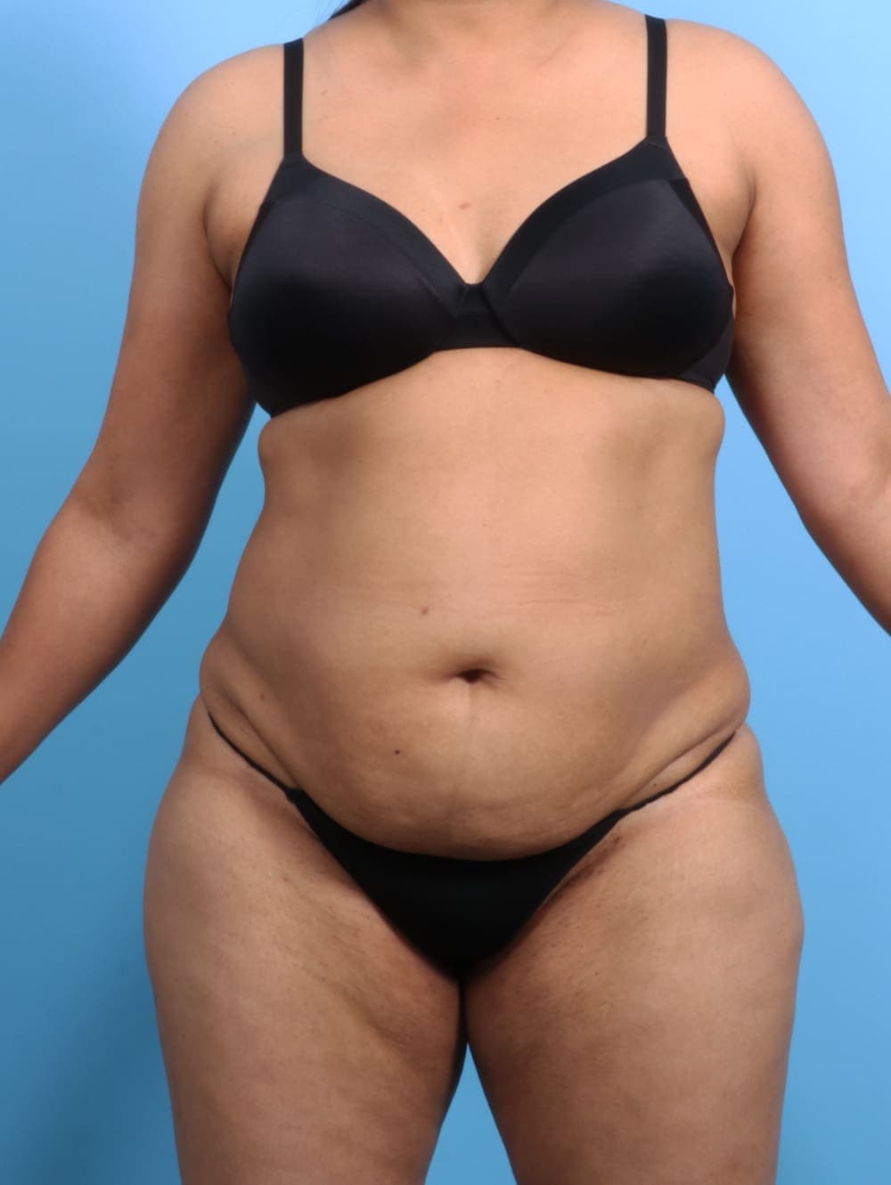Liposuction case #2711 before