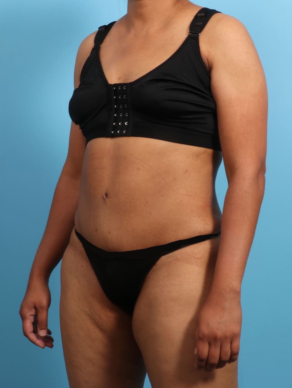 Tummy Tuck case #2711 after, image 2