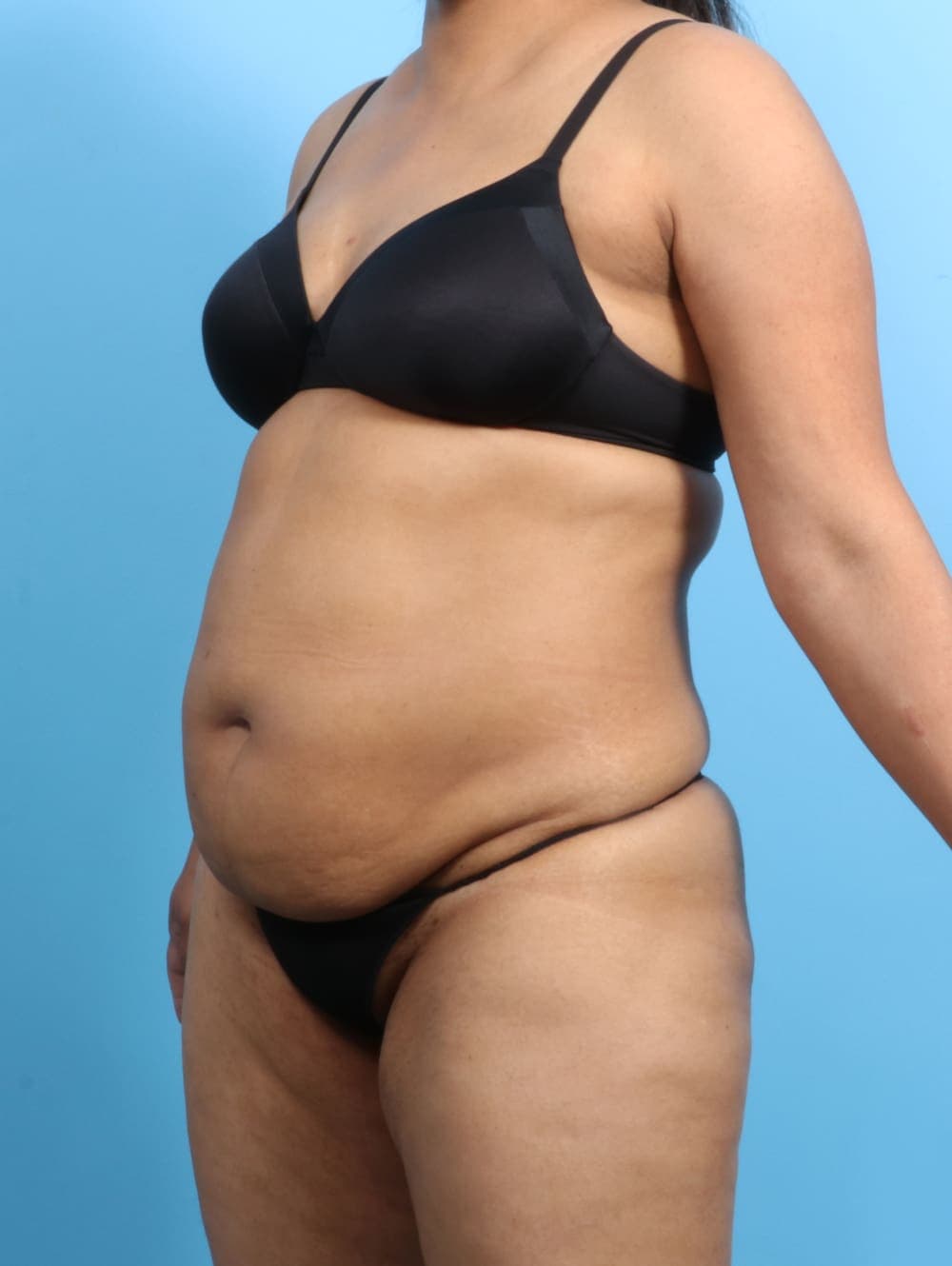 Tummy Tuck case #2711 before, image 2