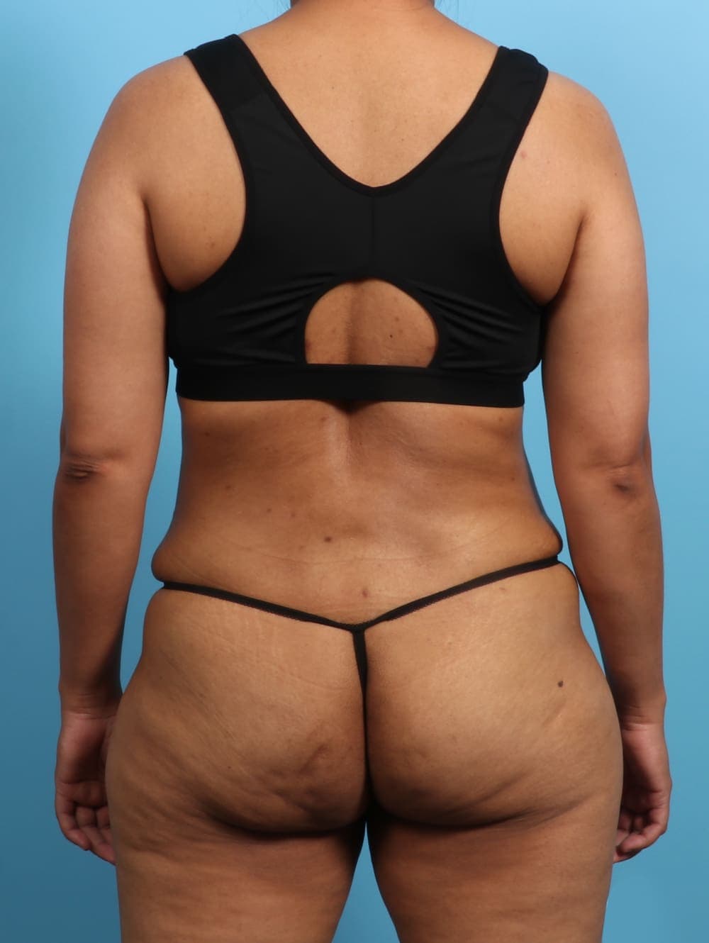 Tummy Tuck case #2711 after, image 4