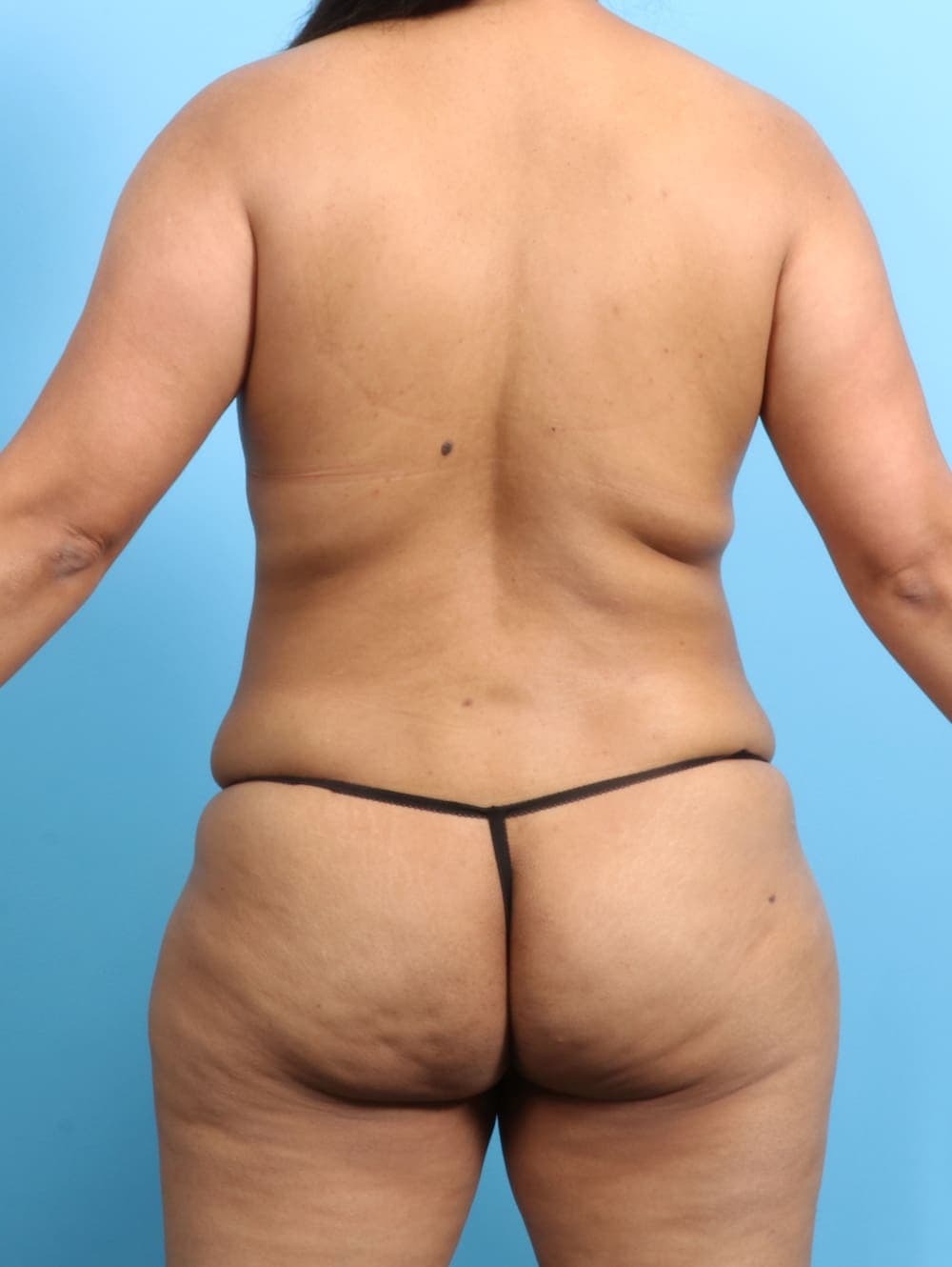 Tummy Tuck case #2711 before, image 4