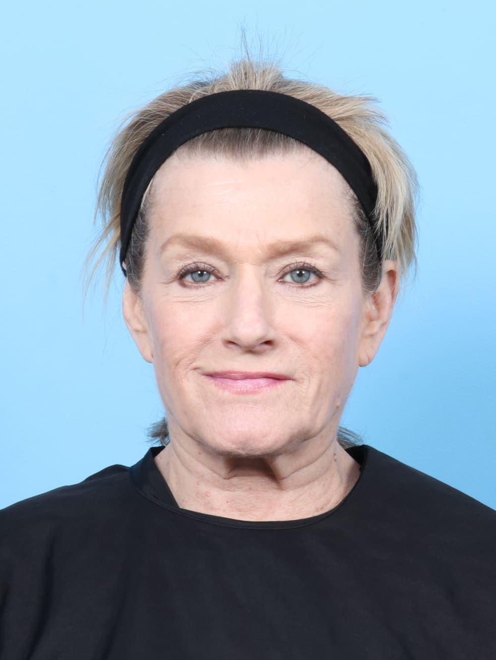 Facial Surgery case #6895 after