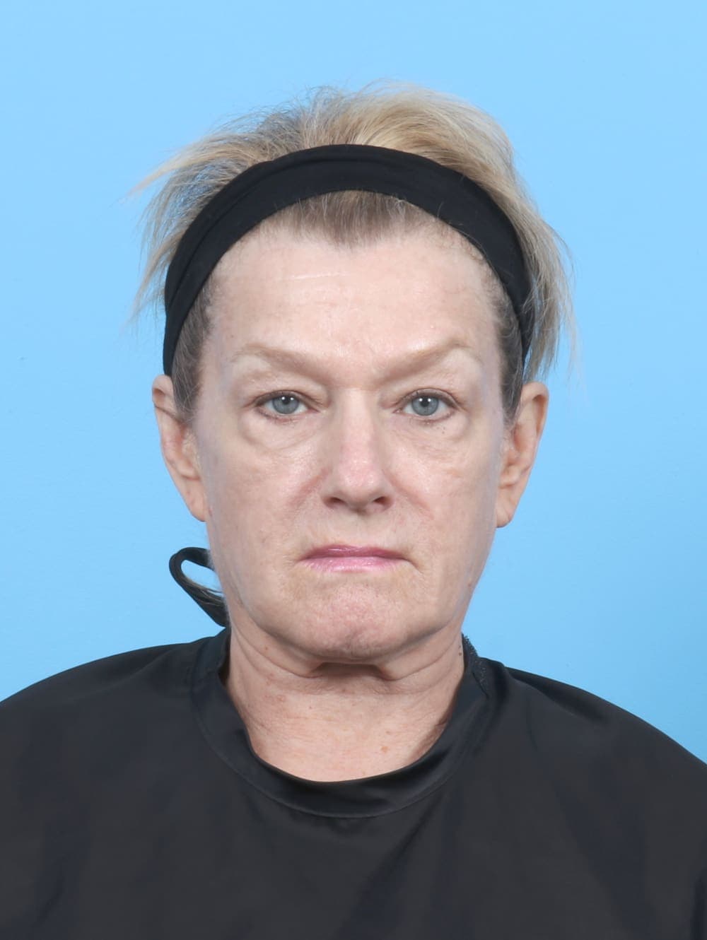 Facial Surgery case #6895 before