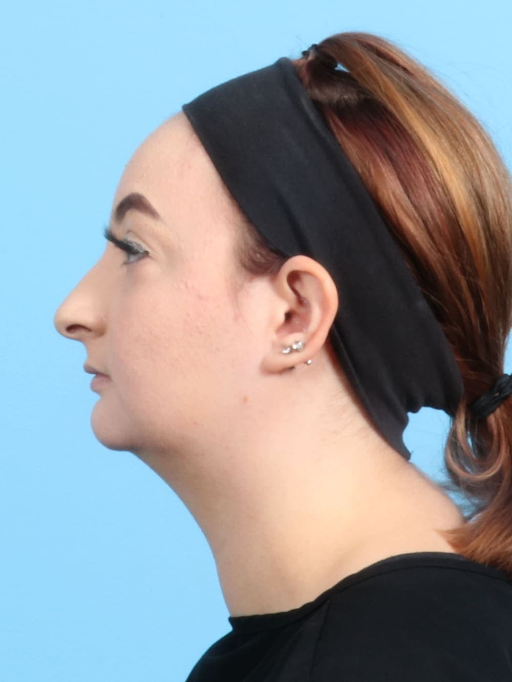 Rhinoplasty case #2528 before