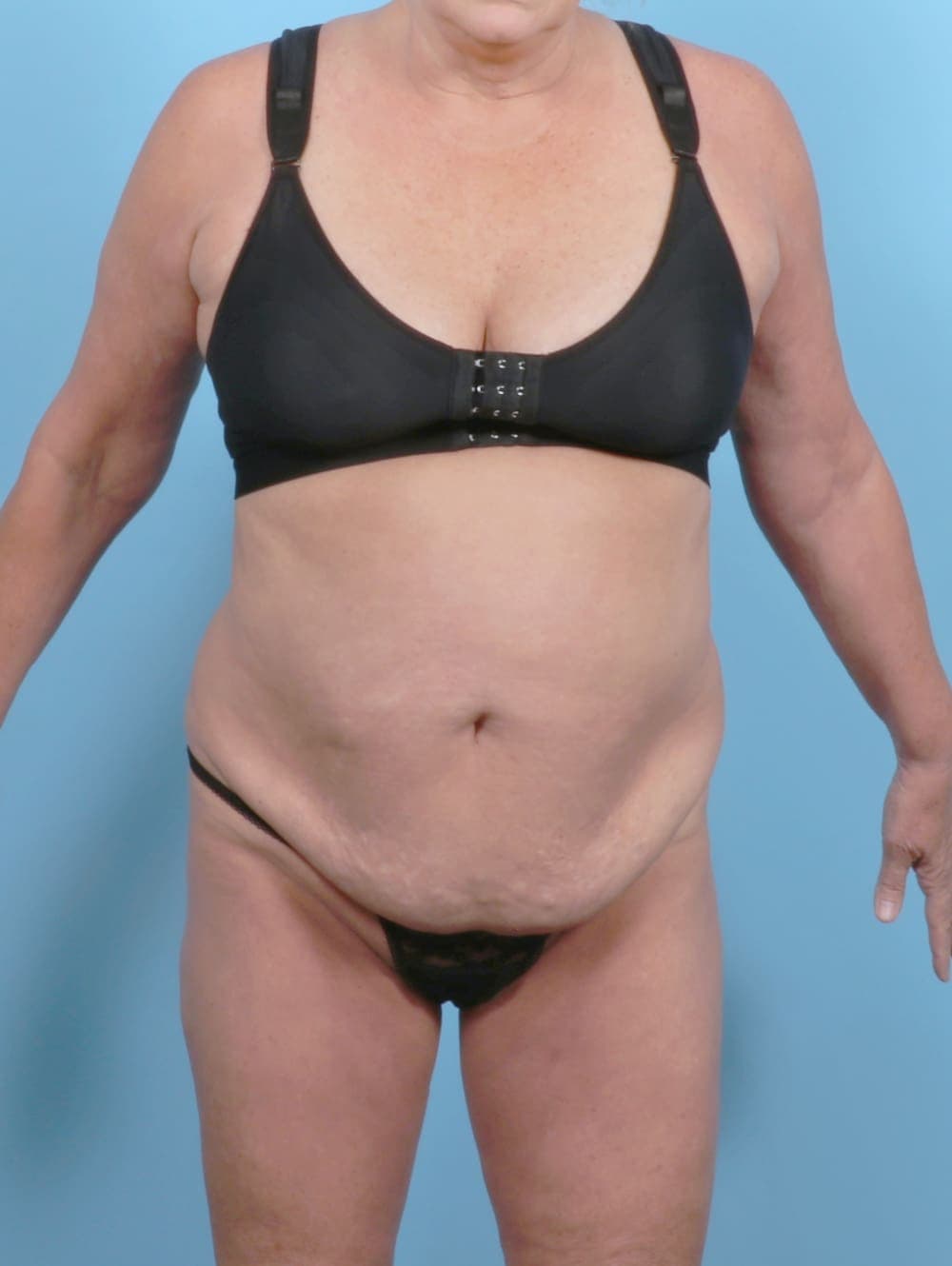 Tummy Tuck case #6301 before