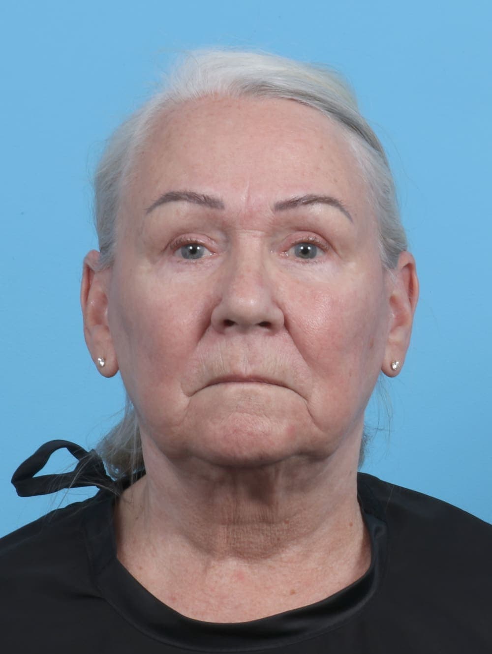 Facial Surgery case #3667 after