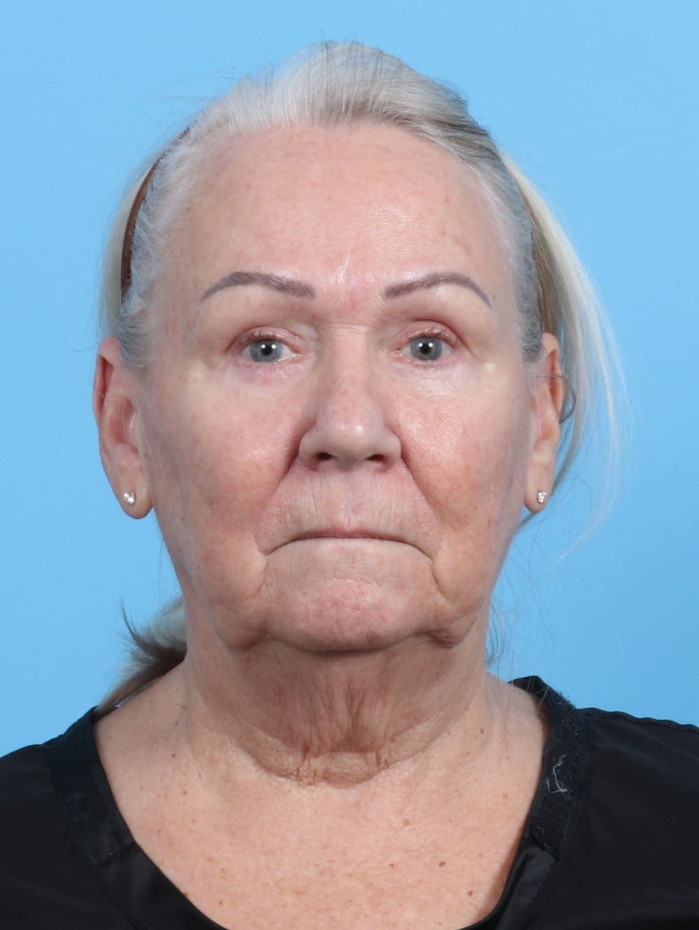 Facial Surgery case #3667 before
